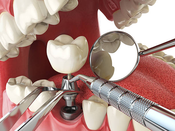 Best Emergency Tooth Extraction in Bayard, NE